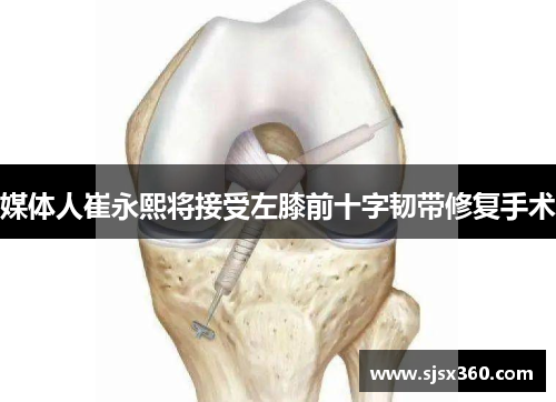 媒体人崔永熙将接受左膝前十字韧带修复手术